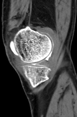 Figure 2 for case Medial meniscus tear ( RID2772 )